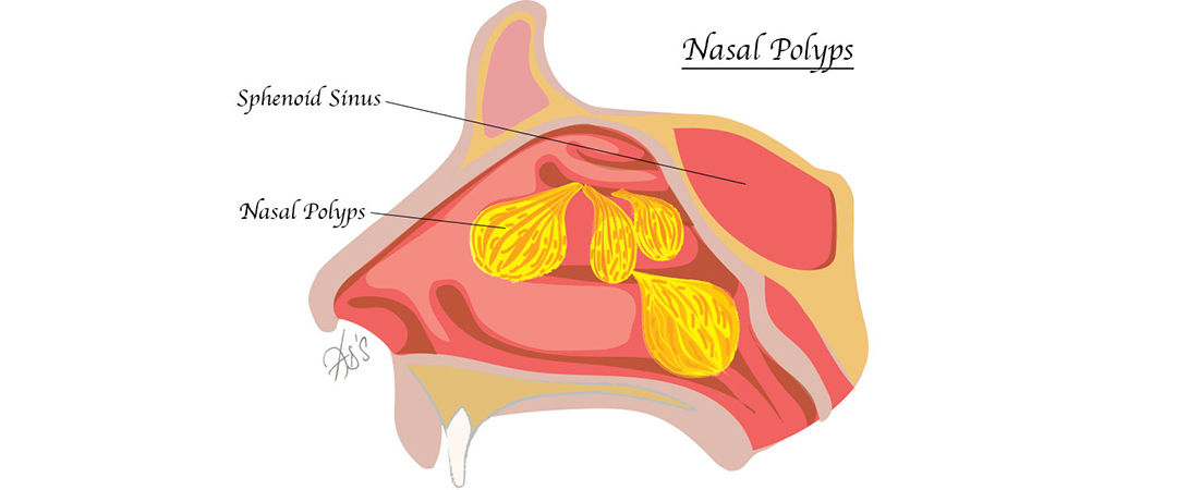 nasal polyps blocked nose
