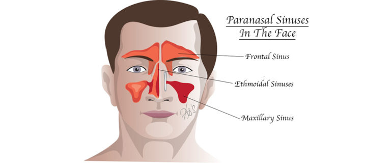 runny-nose-causes-diagnosis-and-how-to-get-rid-of-a-runny-nose